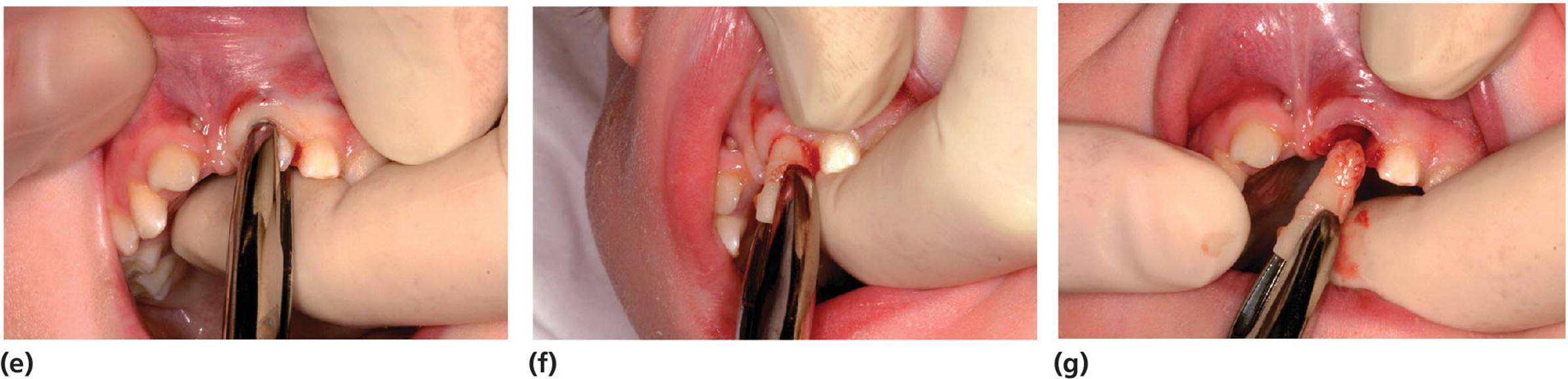Photos displaying the extraction of primary teeth (incisors).