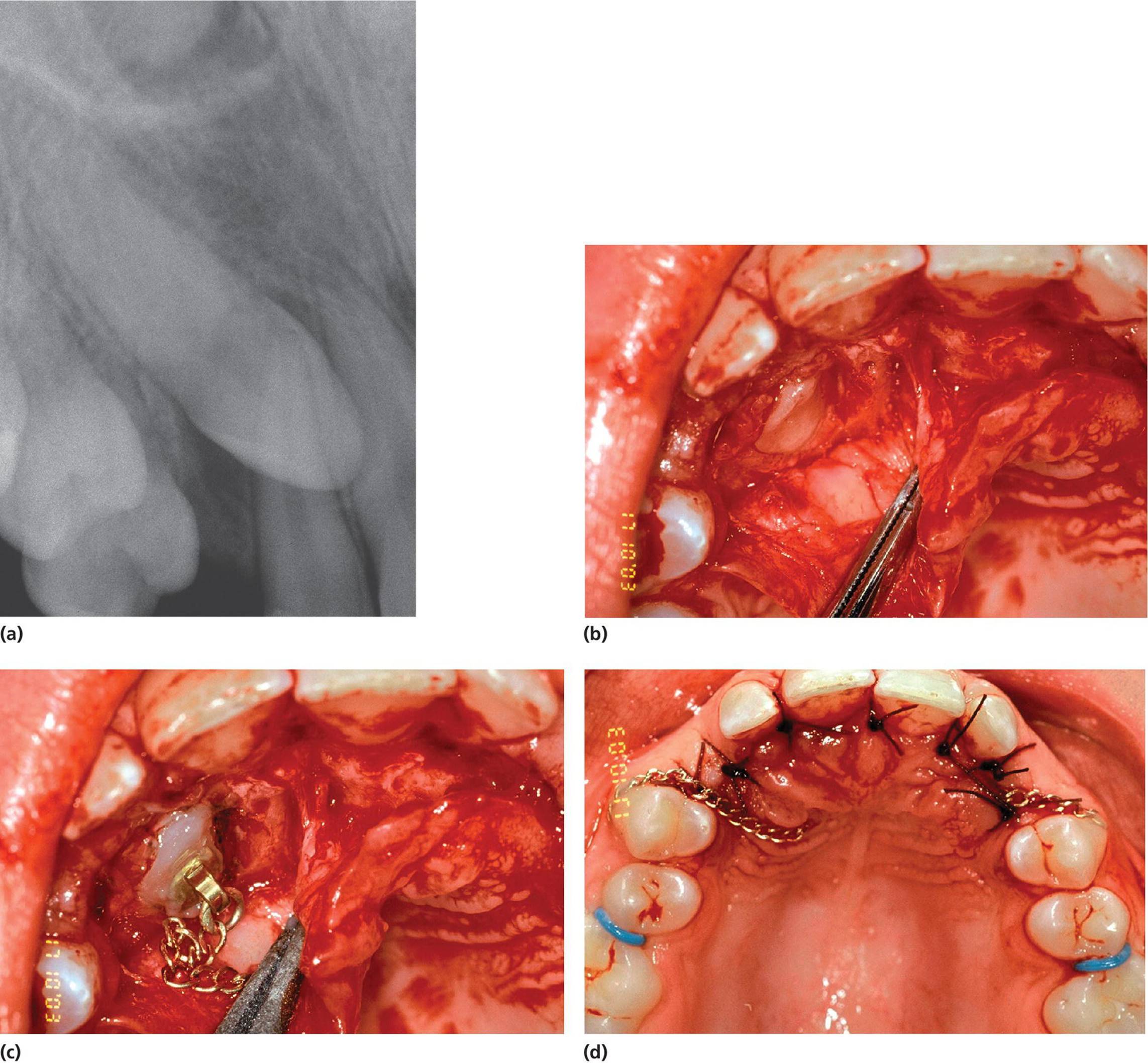 Radiograph of the upper right canine (a) and intraoperative photos of the insertion of brackets and gold chains to the lingual surface of the canine (b,c,d).