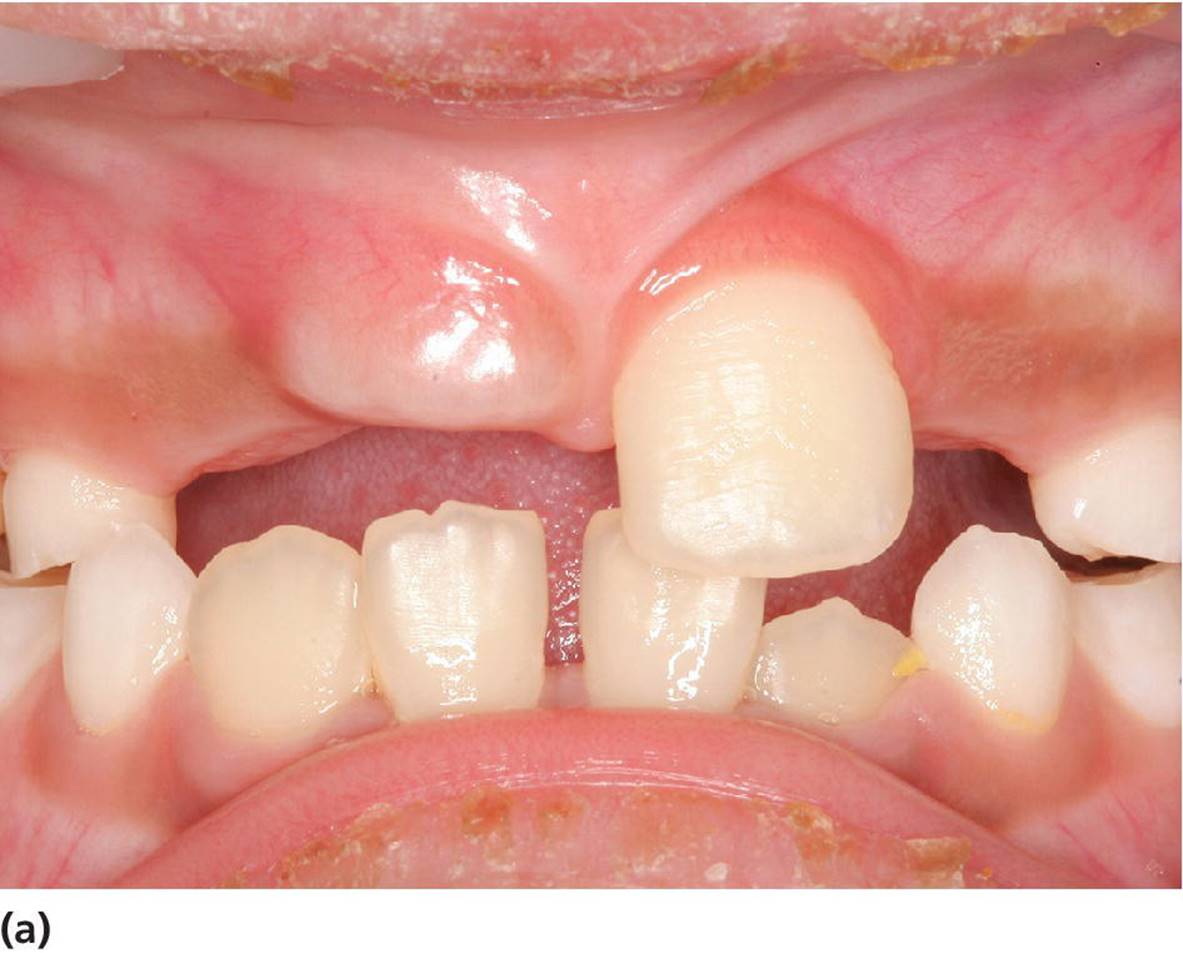 Photo displaying the delayed eruption of upper central incisor.