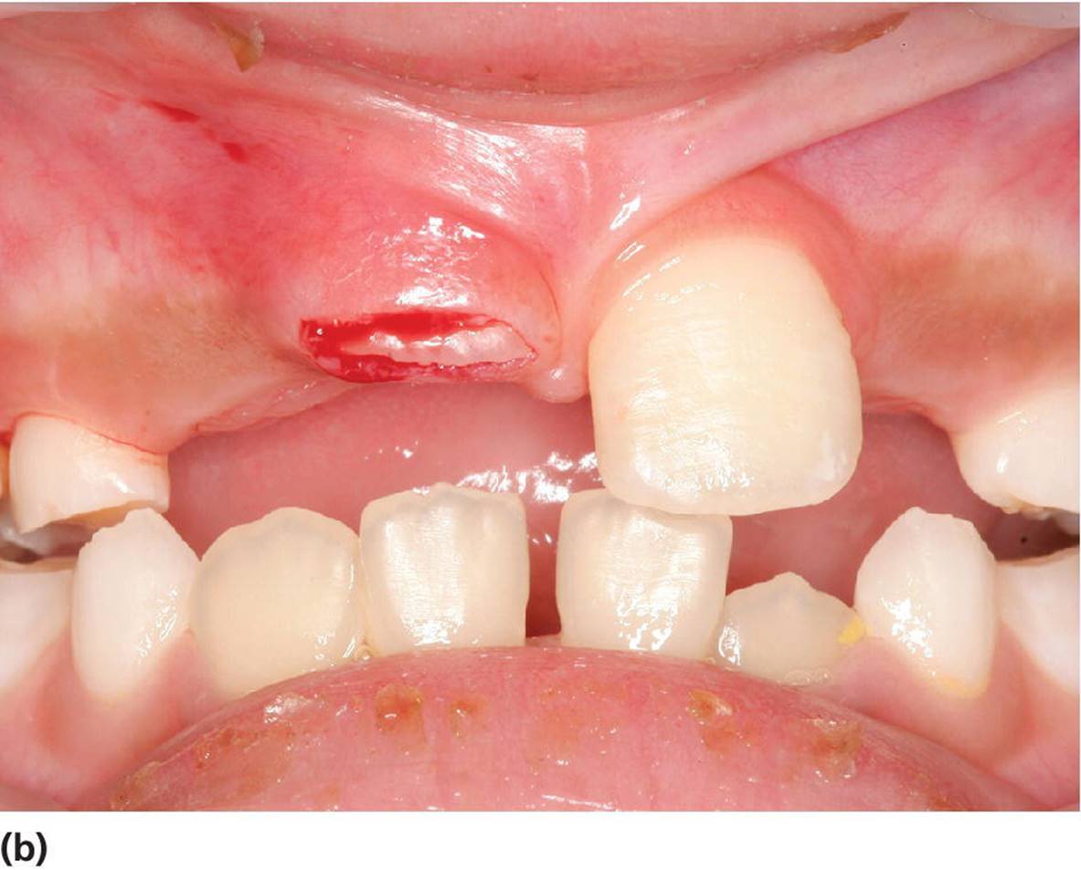 Photo displaying denudation of gingival mucosa to enhance eruption.