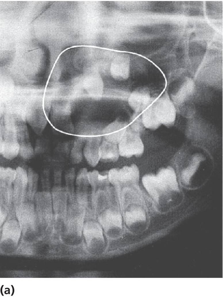 Radiograph displaying extensive dentigerous (follicular) cyst in left maxilla emerging from a supernumerary tooth and displacing tooth germs and disturbing normal eruption.