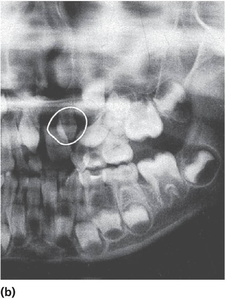 Radiograph of the left maxilla displaying a reduced cyst after 5 months.