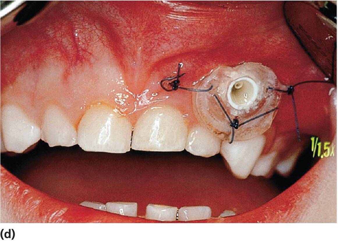 Photo displaying obturator inserted to facilitate rinsing of the cyst.