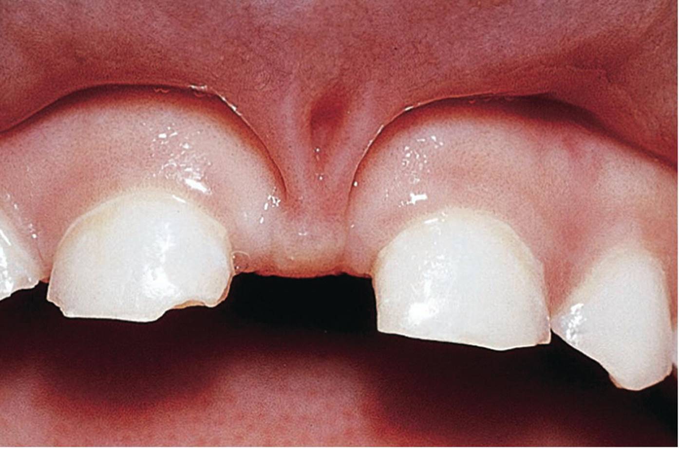 Photo displaying fibrous frenulum causing bony defects.