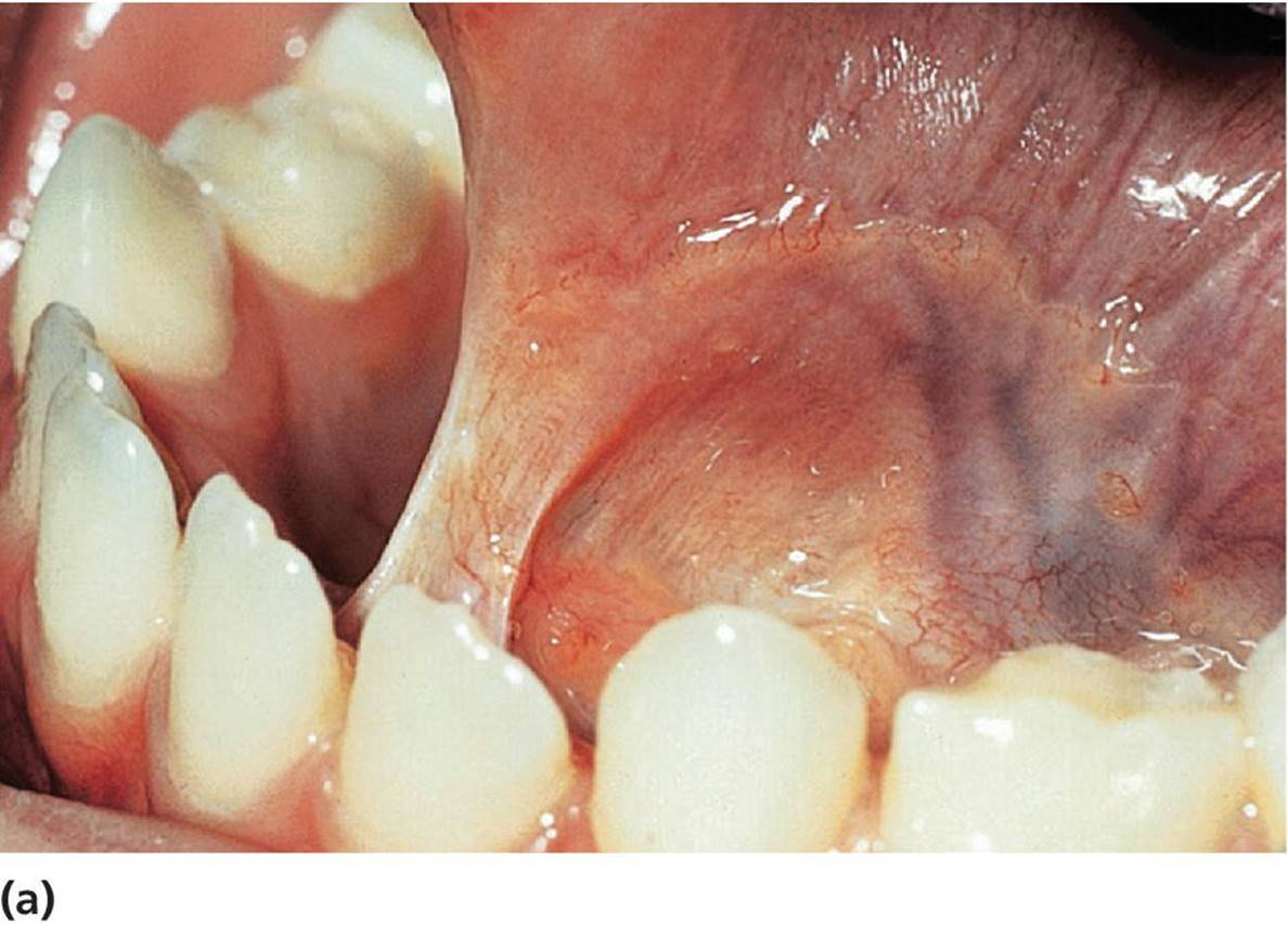 Photo displaying lingual frenulum restricting the movements of the tongue.