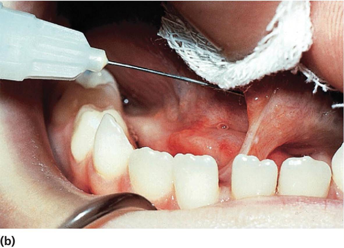 Photo of lingual frenuloplasty displaying the injection of local anesthesia under the tongue.