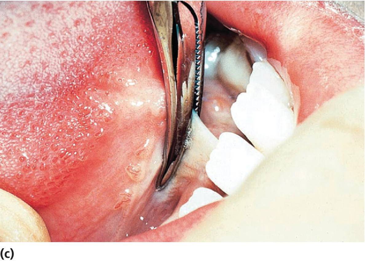 Photo of lingual frenuloplasty displaying curved hemostat placed close to the tongue.