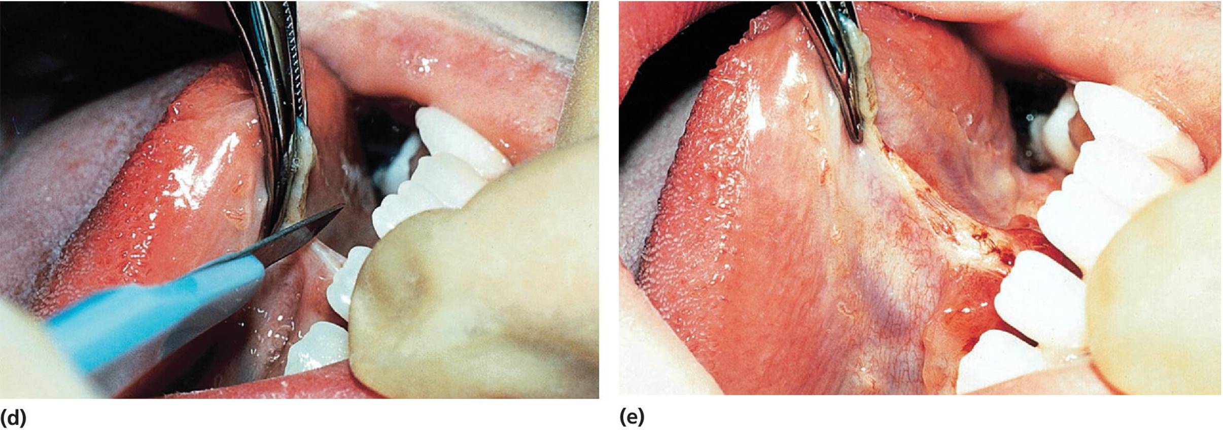 Photo of lingual frenuloplasty displaying frenulum when cut.