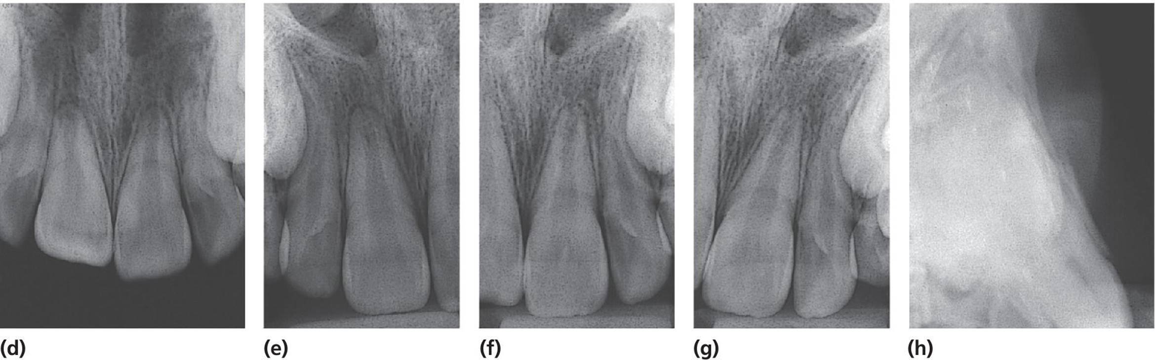 One occlusal and three periapical radiographs presenting buccal displacement of the root (d&ndash;g). Lateral radiograph displays location of the fracture of the buccal bone plate.
