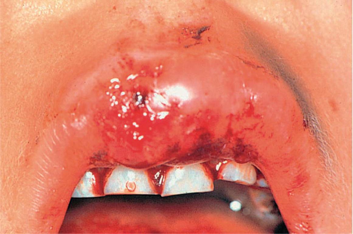 Photo of severe soft tissue damage with extensive hemorrhage displaying both central incisors and right lateral incisor extruded and extremely mobile.