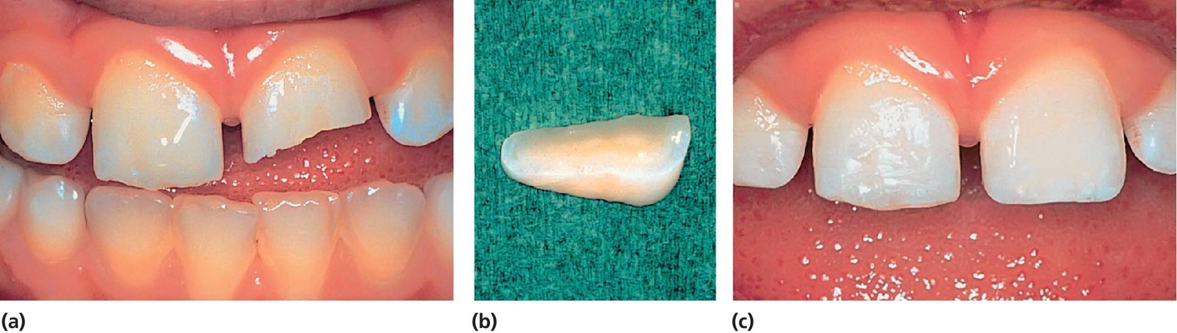Photos displaying enamel&ndash;dentin fracture of the left central incisor in an 8‐year‐old boy (left), fractured crown fragment (center), and condition immediately after reattachment of the fragment (right).