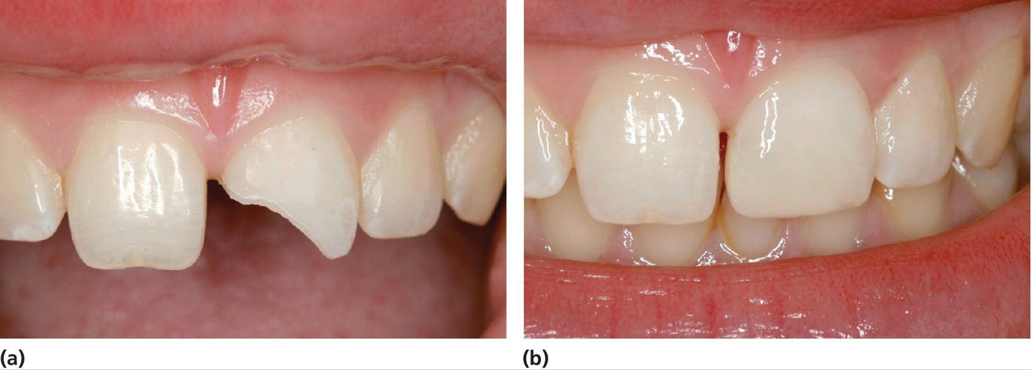 Photos displaying a 12‐year‐old girl with enamel&ndash;dentin fracture of the left central incisor (left) and condition shortly after the composite crown build-up (right).