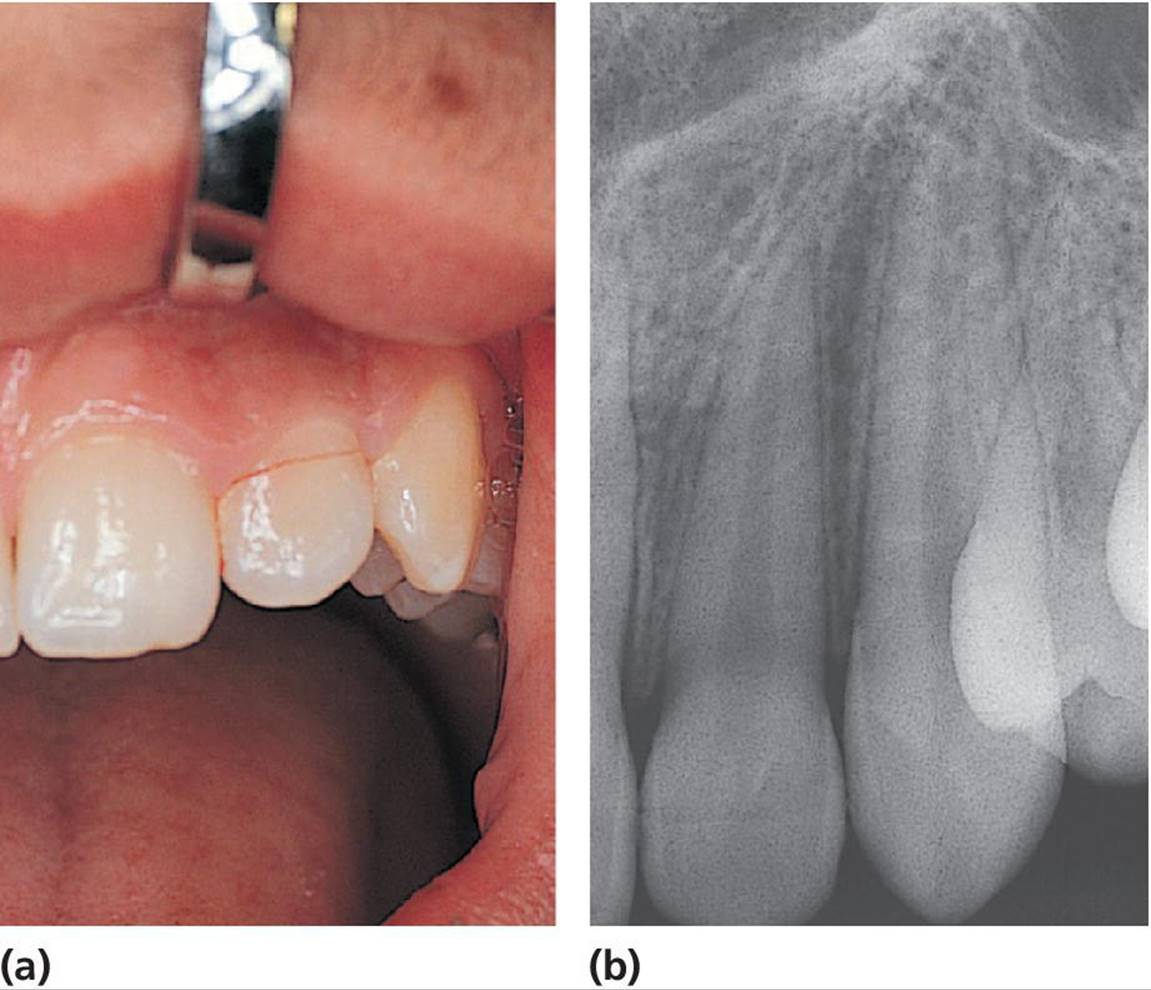 Photo of crown&ndash;root fracture of the left lateral incisor displaying the fracture line, which is located close to the gingival margin (left).; Radiograph of crown&ndash;root fracture of the left lateral incisor illustrating the position of the buccal part of the fracture, whereas the palatal part cannot be seen (right).