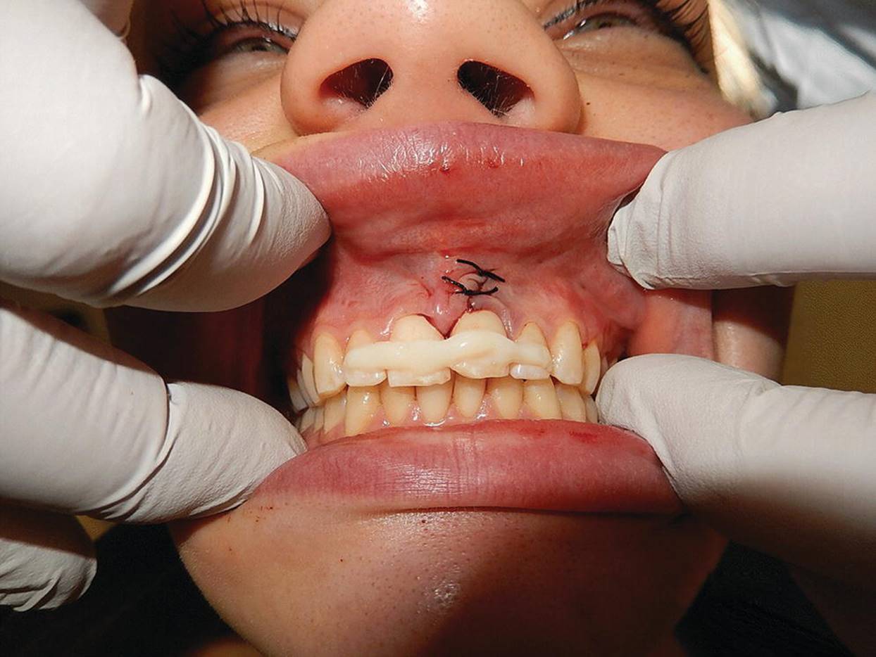 Photo displaying resin splint (Protemp&reg;) applied after surgical repositioning of severely intruded left central incisor.