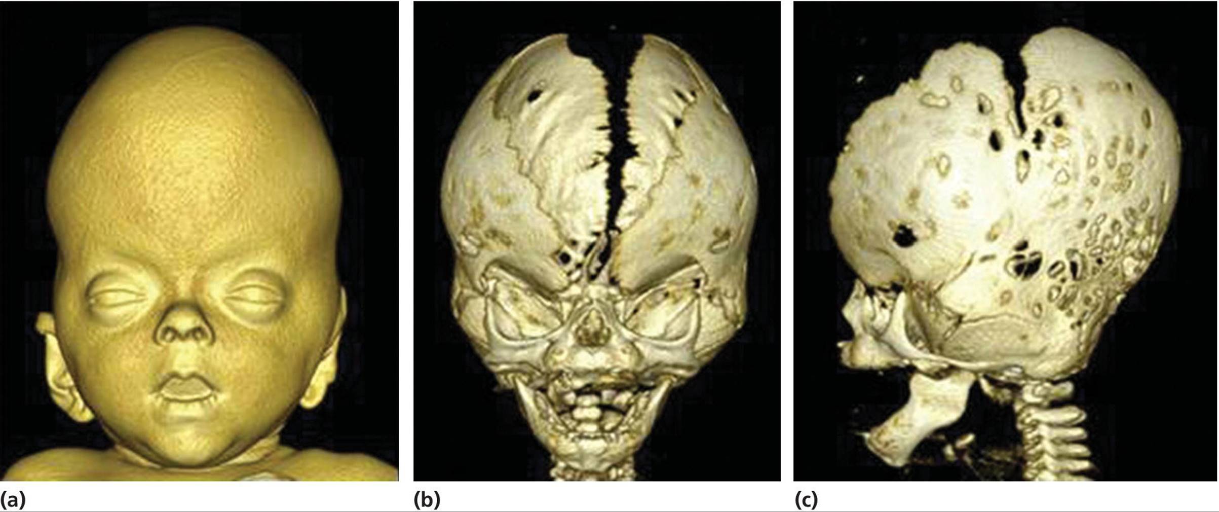 3D CT‐scanning of an infant with Crouzon syndrome, presenting the frontal view with facial soft-tissue morphology (left) and wide calvarial midline defect (middle) and lateral view with synostosis (right).