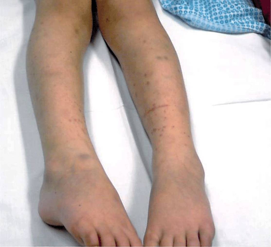 Four-Year-Old Girl - RASH - Symptom-Based Diagnosis in Pediatrics (CHOP ...