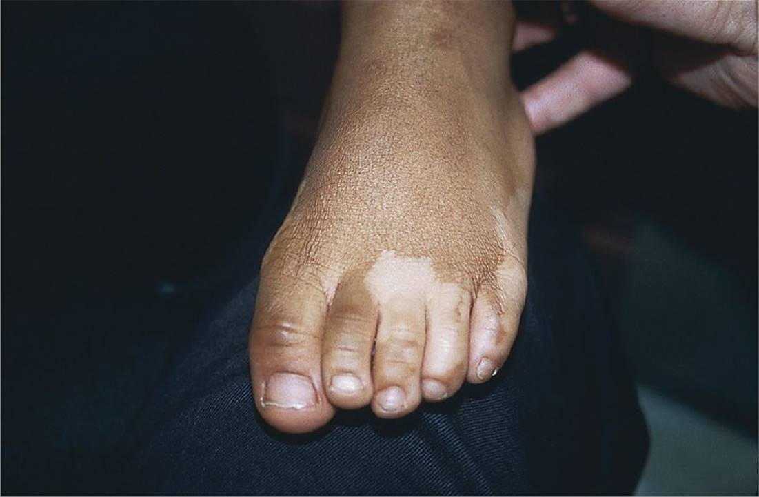 Hypopigmented Reticular Rash Hypopigmented Rashes - Visual Diagnosis and Treatment in Pediatrics, 3 Ed.