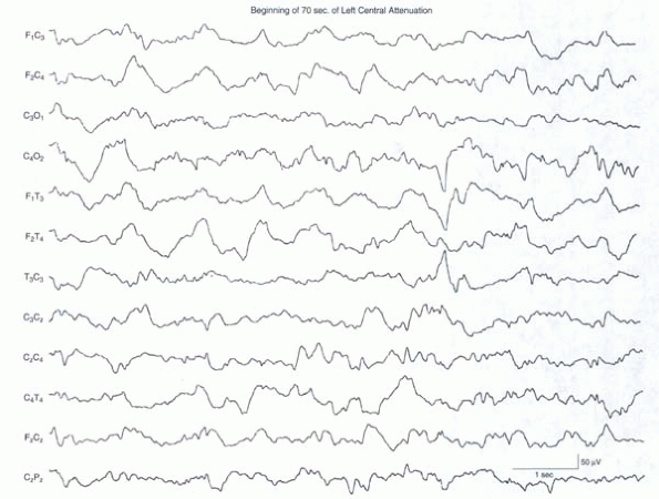 Eeg Normal Waveforms Alpha Beta Delta Theta Frequency Examples ...
