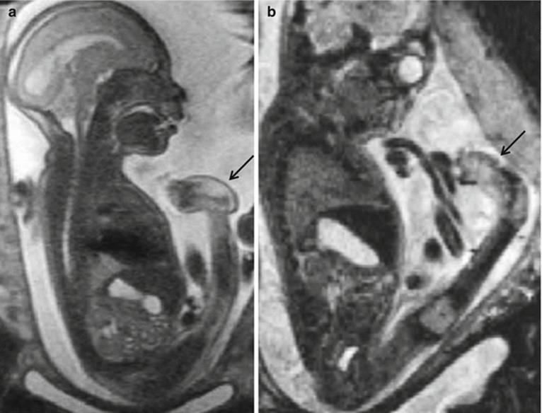 MRI of Fetal Spine and Extremities - MRI of Fetal and Maternal Diseases ...