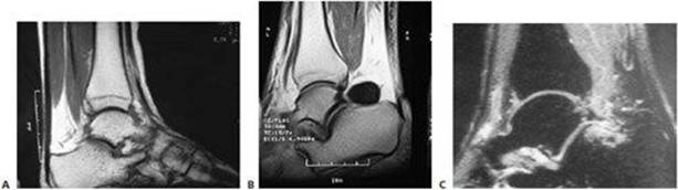 Posterior Ankle Impingement Syndrome - FOOT AND ANKLE - Operative ...
