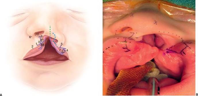 c flap cleft lip Strategic Application of Anatomical Subunit Approximation Technique for Correction of Complete Unilateral lip Cleft Lip: Classification, Clinical Features,