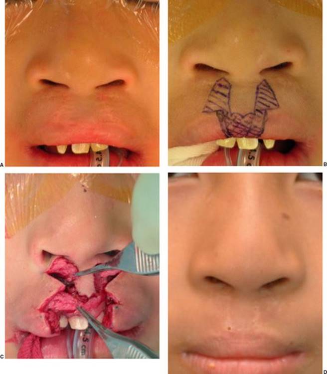 c flap cleft lip Bilateral Repair A comprehensive review of surgical