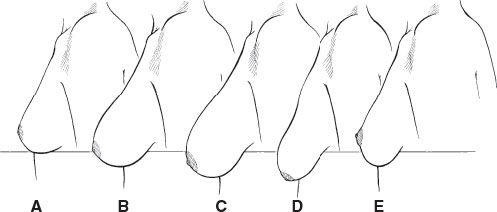 MASTOPEXY AND MASTOPEXY - Plastic surgery