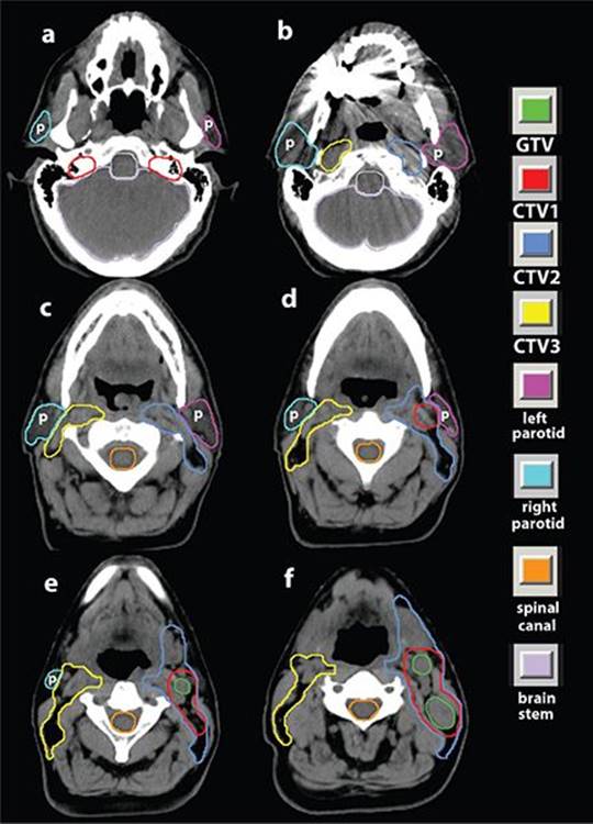 Hypopharynx and Larynx - Practical Essentials of Intensity Modulated ...