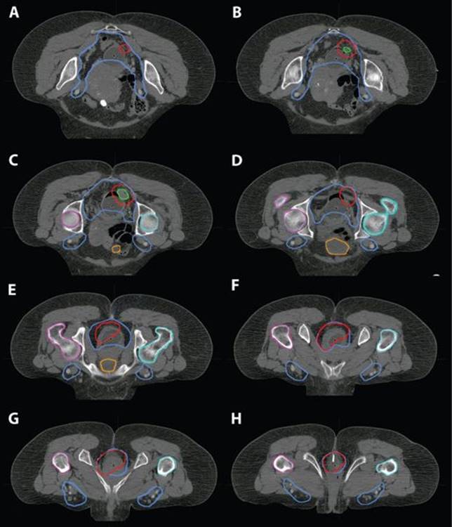 Anal Cancer - Practical Essentials of Intensity Modulated Radiation ...